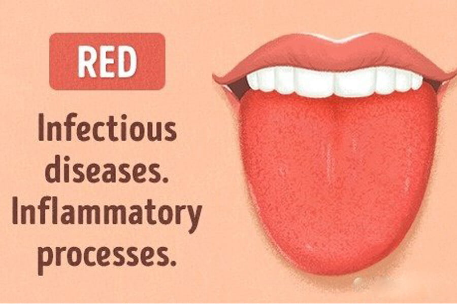 Màu lưỡi đỏ là bệnh gì?